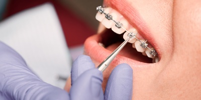 Costo di un apparecchio per i denti: vediamo le diverse tipologie di offerte