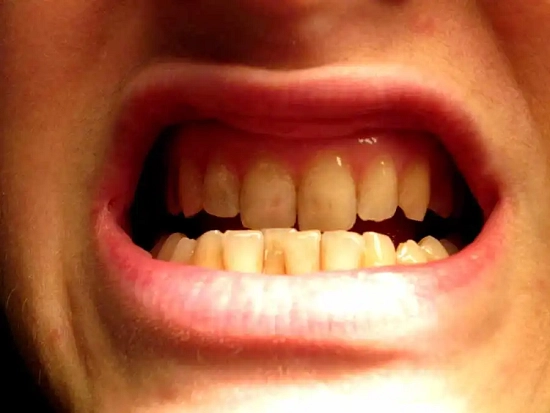 Macchie sui denti: vediamo come evitarle e come rimediare